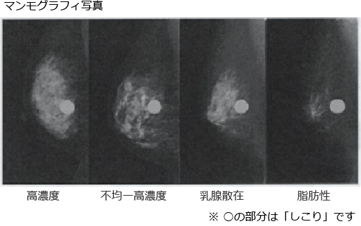 マンモグラフィ写真